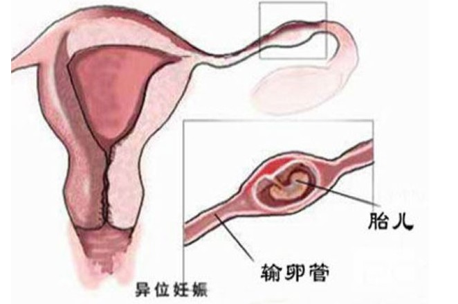 宫外孕的方法所需的住院时间以实施腹腔镜手术