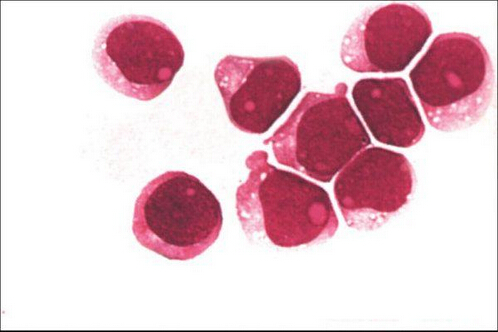 急性粒细胞性白血病（检验图）